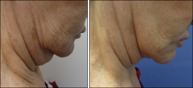facelift